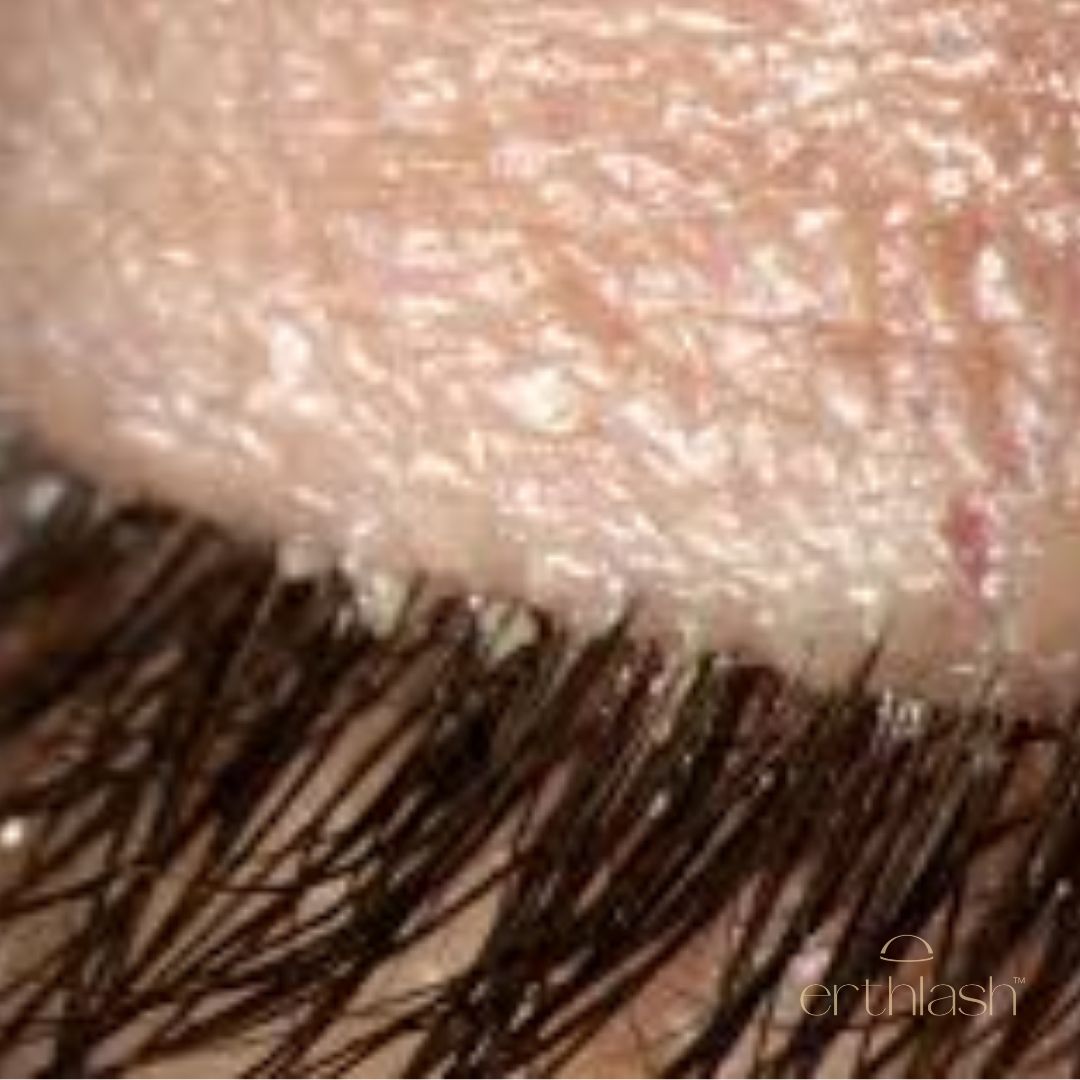 Demodex mites on lash extensions compared to safe natural lash serum alternative